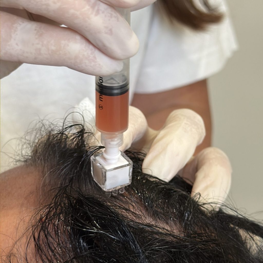 PRF Hair - myclinic Tel-Aviv