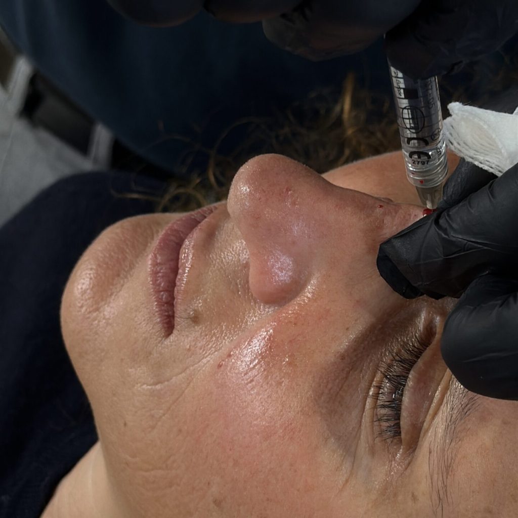 Medical Rhinoplasty – myclinic Tel-Aviv Medical Rhinoplasty - myclinic Tel-Aviv