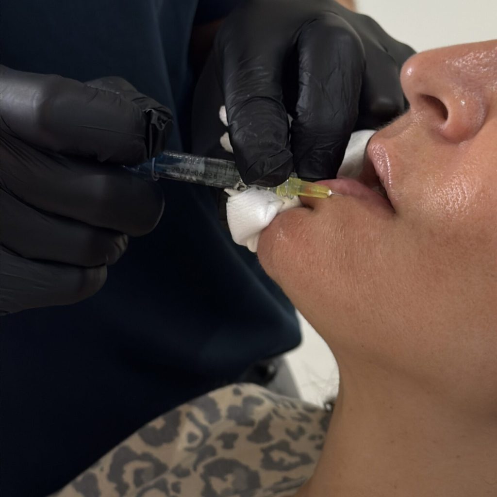 Hyaluronic Acid myclinic Tel-Aviv Hyaluronic Acid myclinic Tel-Aviv