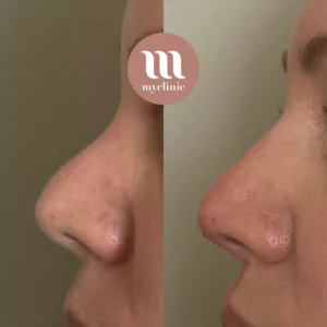 Before / After - Medical Rhinoplasty - myclinic - Tel-Aviv