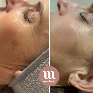Before / After - IPL Lumecca – Sun Spots - myclinic - Tel-Aviv
