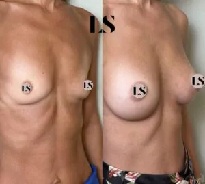 Before / After - Breast Augmentation - by Dr. Samuel Levy - myclinic Tel-Aviv