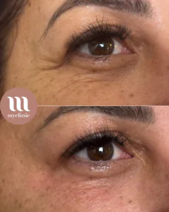 Before / After - 1 Polynucleotide DNA - myclinic Tel-Aviv