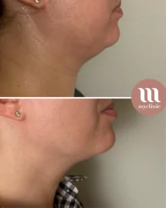 Before / After - Morpheus8 - myclinic - Tel-Aviv