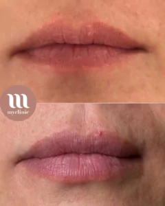 Before / After – Hyaluronic Acid Lip Enhancement - myclinic - Tel-Aviv