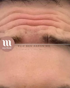 Before / After - Botox Treatment - myclinic - Tel-Aviv