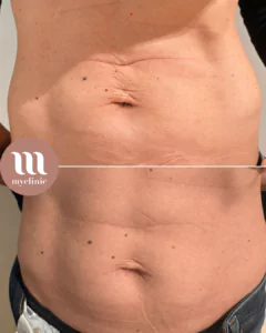 Before / After - Morpheus8 - myclinic - Tel-Aviv