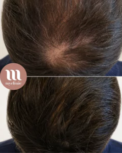 Before / After - PRF Hair treatment - myclinic - Tel-Aviv