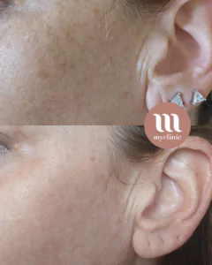 Before / After - IPL Lumecca – Sun Spots - myclinic - Tel-Aviv