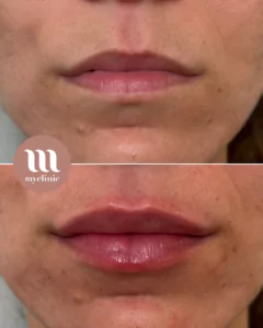 Before / After – Hyaluronic Acid Lip Enhancement - myclinic - Tel-Aviv