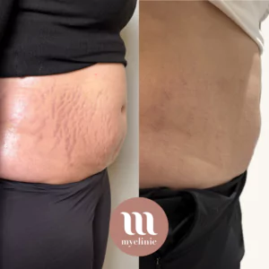 Before / After - Morpheus8 - myclinic - Tel-Aviv