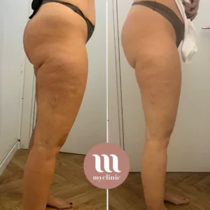 Before / After - LPG - myclinic - Tel-Aviv
