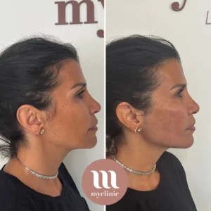 Before / After – HArmonyCA treatment - myclinic - Tel-Aviv