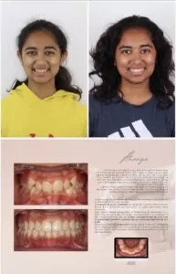 Avant / Après – Traitement orthodontique - Dr Ruben Abou - myclinic Tel-Aviv