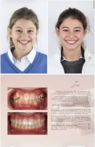 Avant / Après – Traitement orthodontique - Dr Ruben Abou - myclinic Tel-Aviv