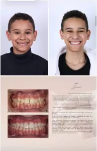 Avant / Après – Traitement orthodontique - Dr Ruben Abou - myclinic Tel-Aviv