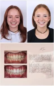 Avant / Après – Traitement orthodontique - Dr Ruben Abou - myclinic Tel-Aviv