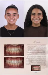Avant / Après – Traitement orthodontique - Dr Ruben Abou - myclinic Tel-Aviv