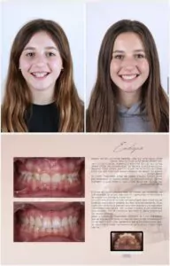 Avant / Après – Traitement orthodontique - Dr Ruben Abou - myclinic Tel-Aviv