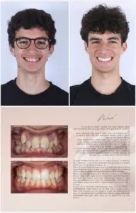 Avant / Après – Traitement orthodontique - Dr Ruben Abou - myclinic Tel-Aviv
