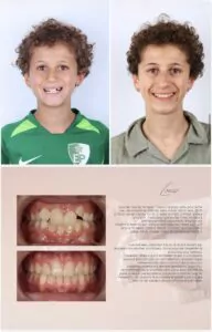 Avant / Après – Traitement orthodontique - Dr Ruben Abou - myclinic Tel-Aviv