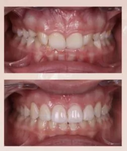 Before / After – Orthodontic Treatment - Dr Ruben Abou - myclinic Tel-Aviv