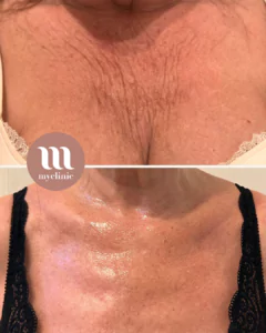 Before / After - Morpheus8 - myclinic - Tel-Aviv