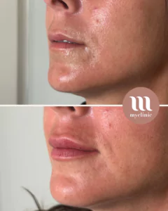 Before / After – Hyaluronic Acid Lip Enhancement - myclinic - Tel-Aviv