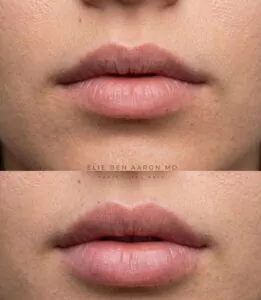 Before / After – Hyaluronic Acid Lip Enhancement - myclinic - Tel-Aviv