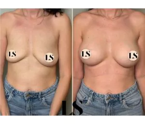 Avant / Après - Augmentation mammaire - par le Dr Samuel Levy - myclinic Tel-Aviv