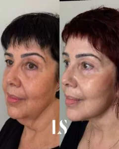 Before-and-after photo of a plastic surgery procedure performed at MyClinic in Tel Aviv