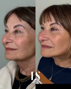 Avant / Après - Lifting du visage et du cou - par le Dr Samuel Levy - myclinic Tel-Aviv