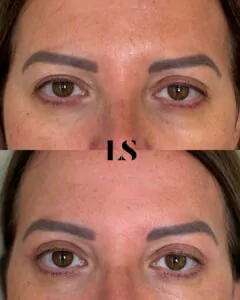 Avant / Après - Blépharoplastie supérieure - par le Dr Samuel Levy - myclinic Tel-Aviv