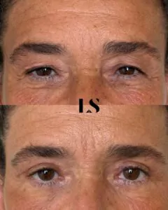 Avant / Après - Blépharoplastie supérieure et inférieure - par le Dr Samuel Levy - myclinic Tel-Aviv